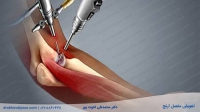 جراحی تعویض مفصل آرنج | دوره بهبودی، عوارض + روشها و هزینه
