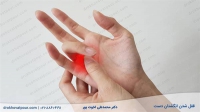 انگشت ماشه ای (قفل شدن انگشتان دست) | تشخیص، علت و روشهای درمان
