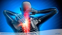 آرتروز گردن: 7 علامت و نحوه تشخیص | درمان، پیشگیری و ورزشها