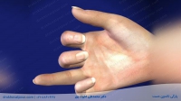 پارگی تاندون دست چیست؟ | علت،علائم مدت بهبودی+ تشخیص و درمان