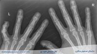 شکستگی استخوان متاکارپ یا کف دست