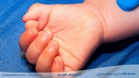 انگشت شست اضافه مادرزادی یا Bifid thumb