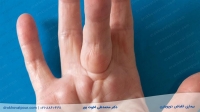 انقباض دوپویترن (Dupuytren) (جمع شدگی انگشتان): علائم و درمان