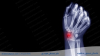 شکستگی استخوان اسکافوئید مچ دست | علائم و تشخیص + درمان